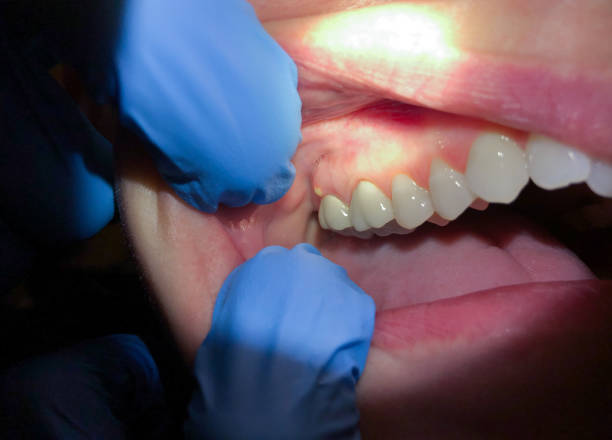 Best Emergency Wisdom Teeth Removal in Ridgemark, CA